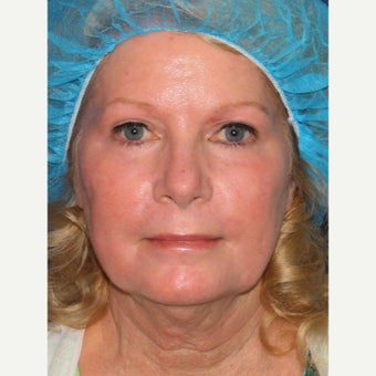 58 year old woman treated with Laser Resurfacing after 1942827
