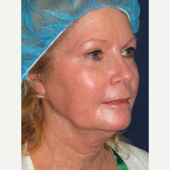 58 year old woman treated with Laser Resurfacing 1942827