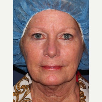 58 year old woman treated with Laser Resurfacing before 1942827