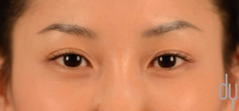 Asian Eyelid Surgery | Asian Blepharoplasty before 1817343