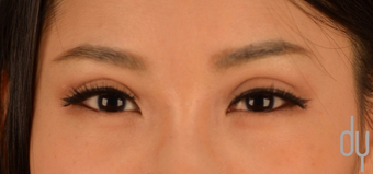 Asian Eyelid Surgery | Asian Blepharoplasty after 1817343