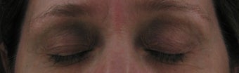 Fraxel for eyelid lift after 275488