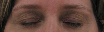 Fraxel for eyelid lift before 275488
