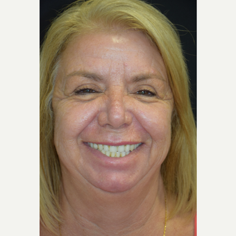 CO2 Laser resurfacing after 3258893