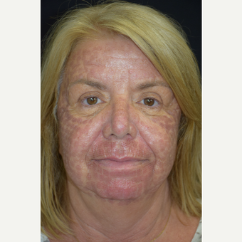 CO2 Laser resurfacing before 3258893