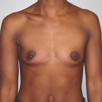 25-34 year old man treated with Breast Augmentation before 3756762