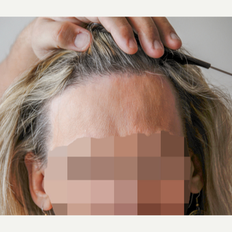 56 year old woman treated with Hair Transplant after 3340111