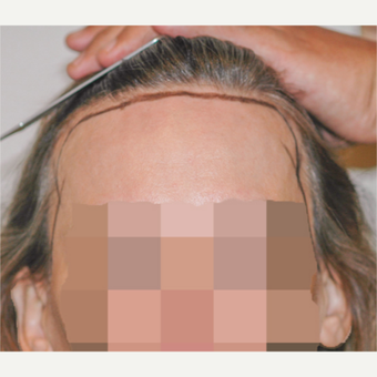 56 year old woman treated with Hair Transplant before 3340111