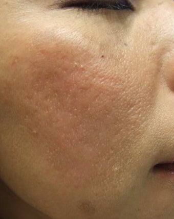 Acne Scar Removal Before and After Pictures after 1032282