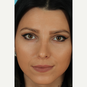 25-34 year old woman treated with Rhinoplasty after 3628770