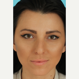 25-34 year old woman treated with Rhinoplasty before 3628770