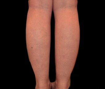 35-44 year old woman treated with Body Jet before 2281666