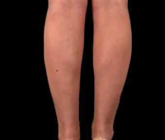 35-44 year old woman treated with Body Jet after 2281666