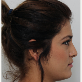 18-24 year old woman treated with Revision Rhinoplasty after 3582926