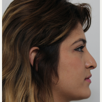 18-24 year old woman treated with Revision Rhinoplasty before 3582926