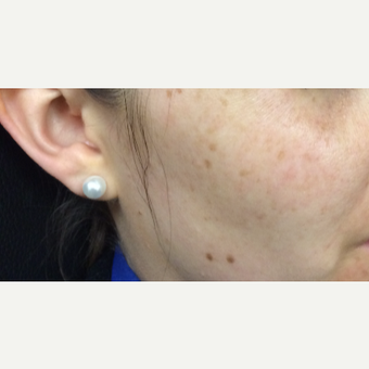 25-34 year old woman treated with PicoSure Skin Revitalization before 3246785
