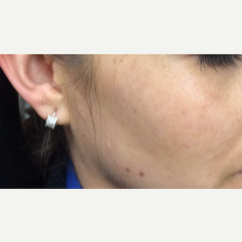 25-34 year old woman treated with PicoSure Skin Revitalization after 3246785