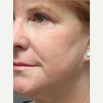55-64 year old woman treated with Chemical Peel after 3645612