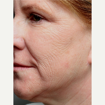 55-64 year old woman treated with Chemical Peel before 3645612