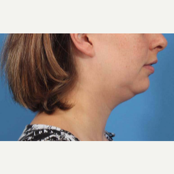 25-34 year old woman treated with Chin Liposuction before 3787641