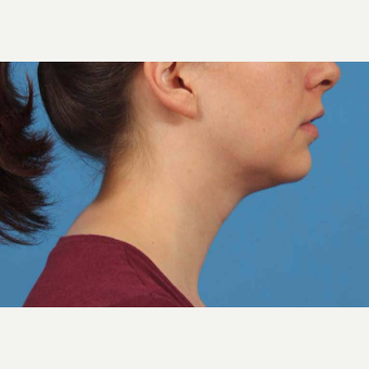 25-34 year old woman treated with Chin Liposuction after 3787641