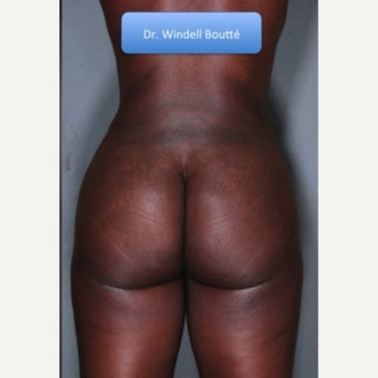 25-34 year old woman treated with Fat Transfer after 1651755