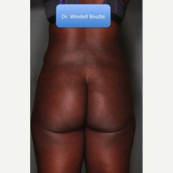 25-34 year old woman treated with Fat Transfer before 1651755