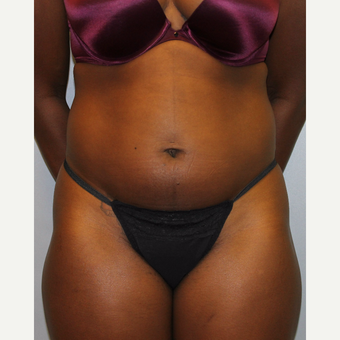 25-34 year old woman treated with Liposuction before 3564309
