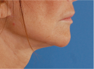 65-74 year old woman treated with Facelift 3037624