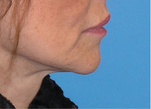 65-74 year old woman treated with Facelift 3037624