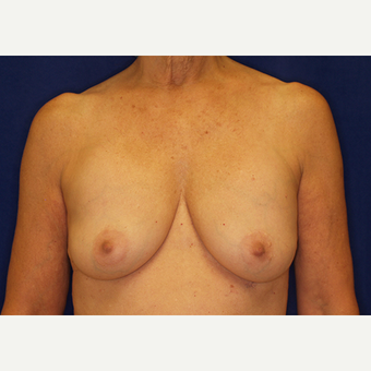 35-44 year old woman treated with Breast Lift with Implants before 3061253