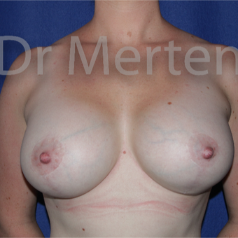 25-34 year old woman treated with Breast Lift with Implants after 3595431