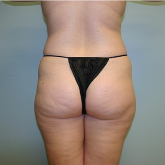 Brazilian Butt Lift before 3667607