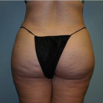 Brazilian Butt Lift after 3667607