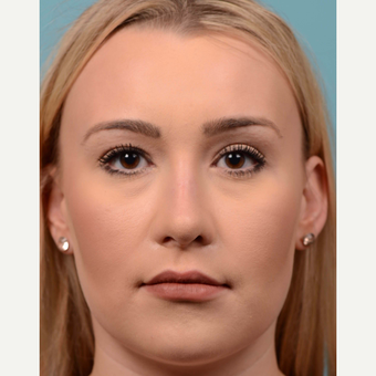 25-34 year old woman treated with open Rhinoplasty/Septoplasty after 3064772