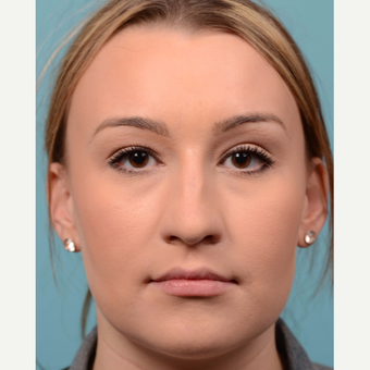 25-34 year old woman treated with open Rhinoplasty/Septoplasty before 3064772