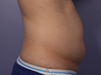 CoolSculpting to Abdomen before 581861