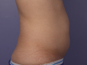 CoolSculpting to Abdomen after 581861