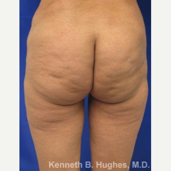 Body Lift before 3100152
