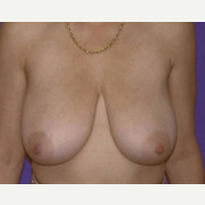45-54 year old woman treated with Breast Lift before 3423719