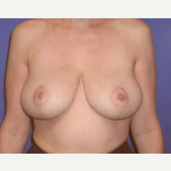 45-54 year old woman treated with Breast Lift after 3423719