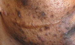 Scar revision before 1433306