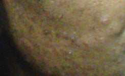 Scar revision after 1433306