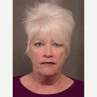 55-64 year old woman treated with Facelift before 3530258