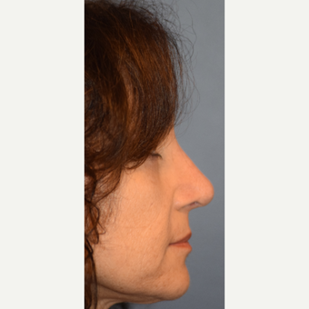 55-64 year old woman treated with Rhinoplasty after 3245666