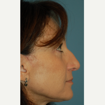 55-64 year old woman treated with Rhinoplasty before 3245666
