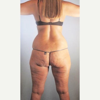 35-44 year old woman treated with Liposuction before 2508708