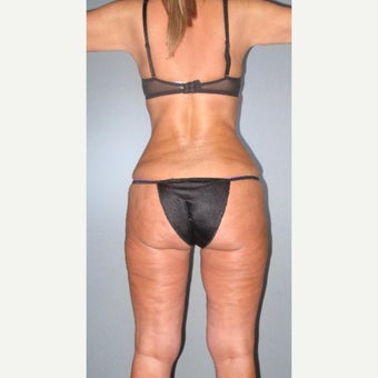 35-44 year old woman treated with Liposuction after 2508708