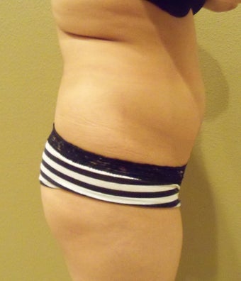 22 year old woman with butt augmentation 1250912