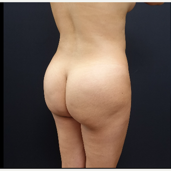 25-34 year old woman treated with Liposculpture before 3286494